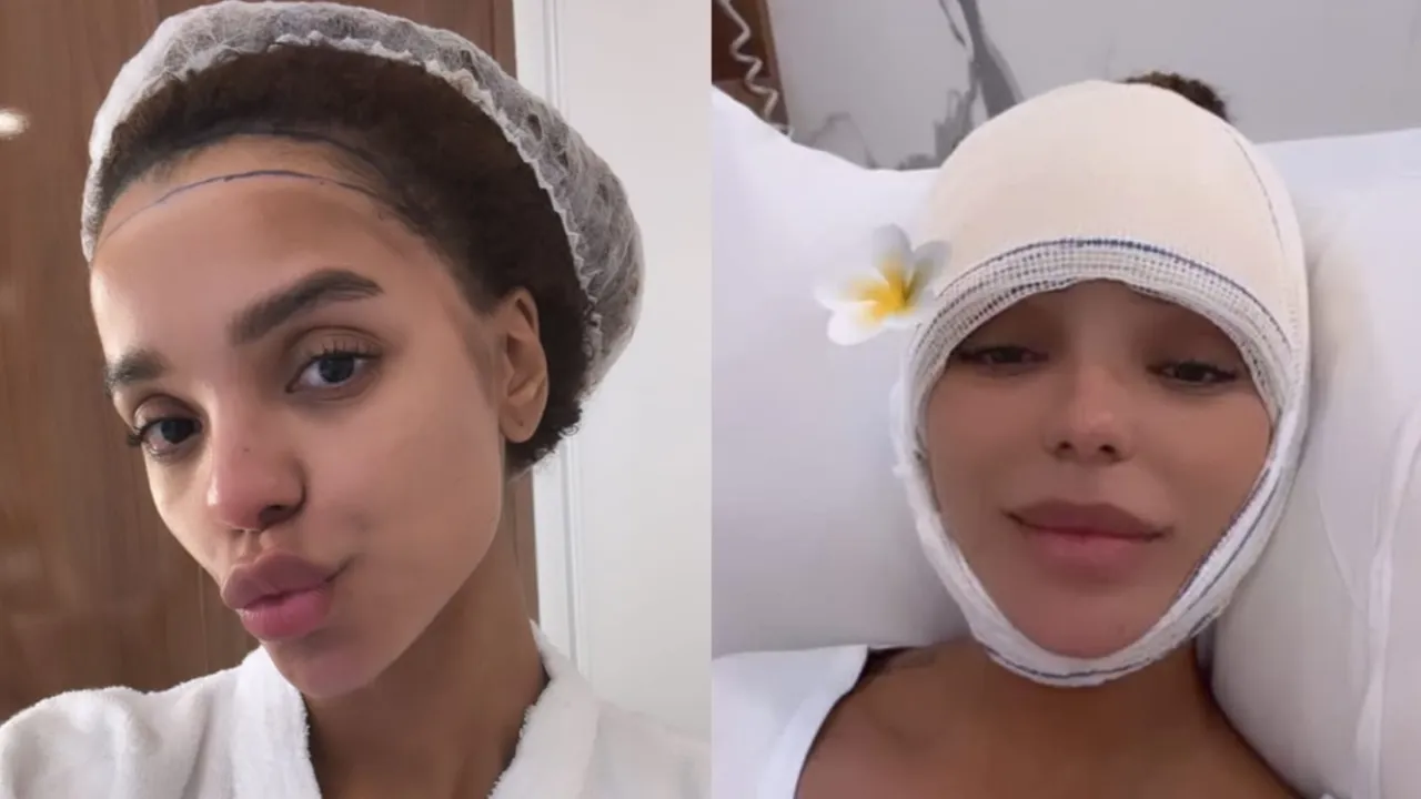 BRUNNA GONÇALVES SHARES WITH FOLLOWERS REACTION AFTER SEEING THE RESULT OF FOREHEAD REDUCTION